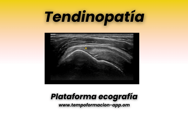 3. Tendon supraespinoso ecografia y patologia.png